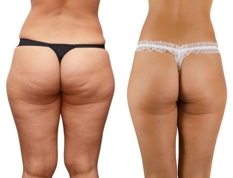 Addio cellulite con l'Alga Guam