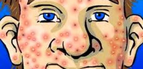 Acne: curarla con gli oli essenziali