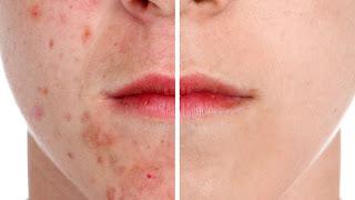 MILANO. 4 milioni di adolescenti in Italia soffrono di acne ed il 68% non va dal medico curandosi con il fai-da-te.