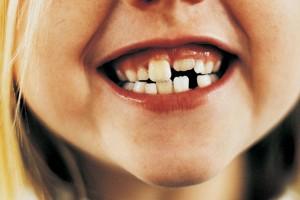 Chiedi al dentista: quando devono cadere i denti da latte?