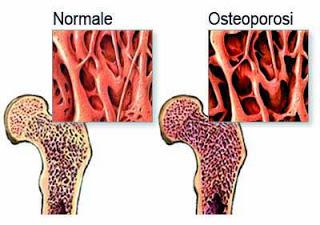 PAVIA. Presentazione oggi della Giornata mondiale dell'osteoporosi. Saranno premiati i dipendenti con 25 anni di servizio nell'ASP.