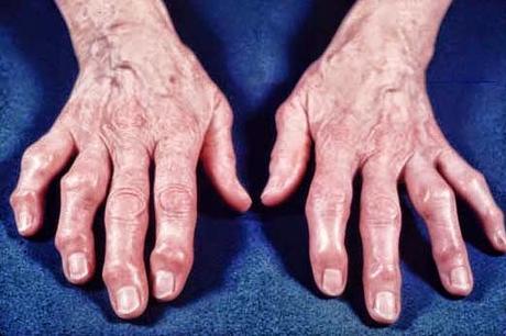 Artrite e atrosi, Ascessi, Asma, trattarli con gli oli essenziali