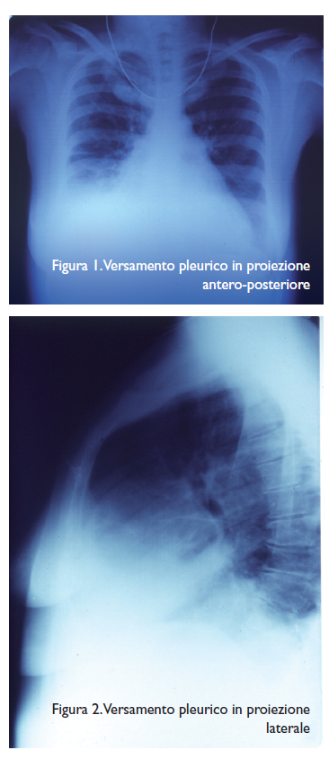 Versamento pleurico