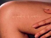 Cicatrici: degli essenziali