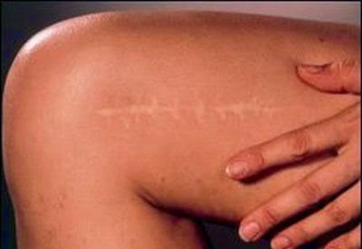 Cicatrici: uso degli oli essenziali |