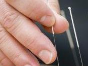 Emicrania altri disturbi: risparmiare l'agopuntura