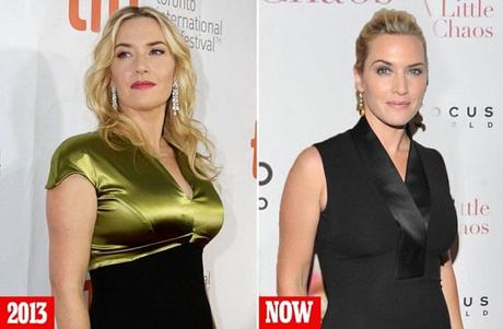 kate-winslet-botox