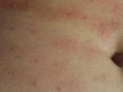 Eruzioni cutanee, degli essenziali