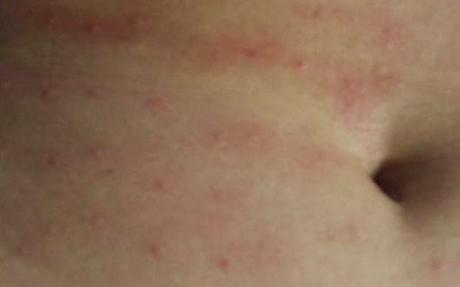 Eruzioni cutanee, uso degli oli essenziali