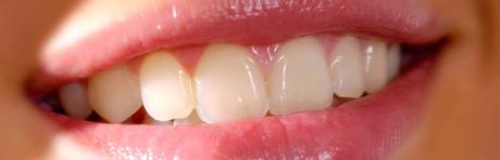 Gengiviti e ulcerazioni orali come curarle con gli oli essenziali