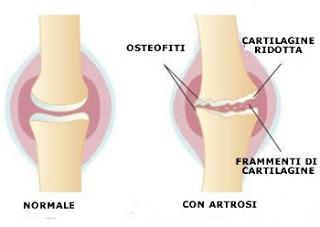 MILANO. Articolazioni a rischio con obesità e sovrappeso: in Italia 4 milioni di persone con osteoartrosi, metà sono obesi.