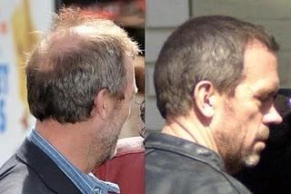 Il Dr. House ha il parrucchino? Hugh Laurie necessita un ritocchino