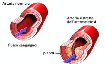 aterosclerosi_Fotor