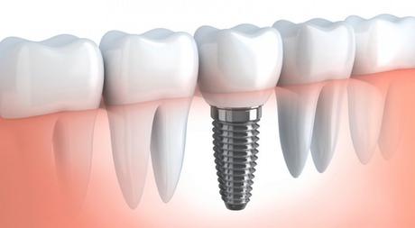 implantologia osteointegrata