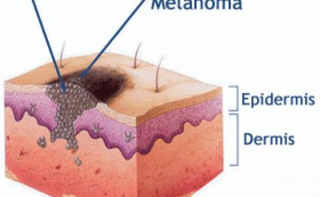 melanoma_Fotor