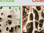 MILANO. Tumore seno osteoporosi, legame noto temuto scarsa attenzione alle ossa secondo studio ONDA.