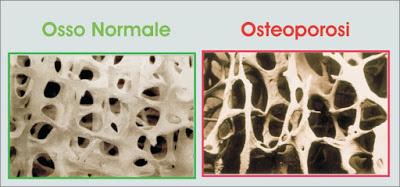 MILANO. Tumore al seno e osteoporosi, legame noto e temuto ma scarsa attenzione alle ossa secondo uno studio di ONDA.