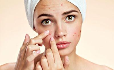 aloe vera contro acne