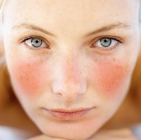 6 TIPS PER CONVIVERE CON UNA PELLE SENSIBILE rosacea-cilt-bakimi