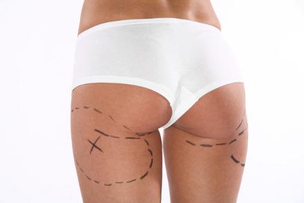 Prendi sempre in Considerazione il Prezzo di una Liposuzione