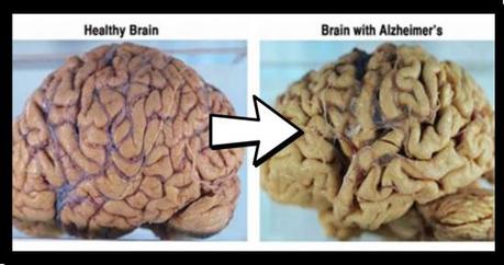 Novità su Alzheimer: si può prevenire e perfino far regredire Novità su Alzheimer: si può prevenire e perfino far regredire