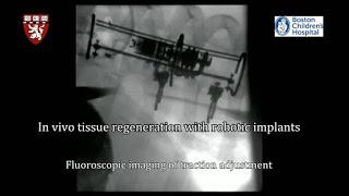 Robot medico stimola la crescita di organi rachitici Robot medico stimola la crescita di organi rachitici