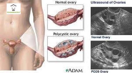 Soffrite di PCOS o sindrome dell’Ovaio Policistico? Ecco la dieta adatta a voi Soffrite di PCOS o sindrome dell’Ovaio Policistico? Ecco la dieta adatta a voi