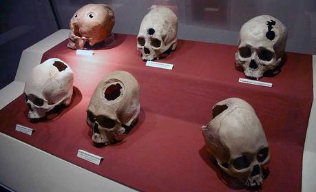 Trapanazione del cranio: il successo degli Inca Serie di crani di pazienti sottoposti a trapanazione in epoca precolombiana. Museum of Anthropology, Archaeology and History, Lima