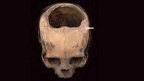 Trapanazione del cranio: il successo degli Inca Questo individuo vissuto in Perù tra il 400 e il 200 a.C. ha subito una frattura cranica (freccia bianca) trattata probabilmente con una trapanazione, morendo circa due settimane dopo l'intervento.