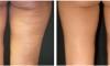 Cure e rimedi per la ritenzione idrica e la cellulite