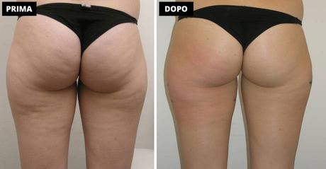 rimedi cellulite glutei