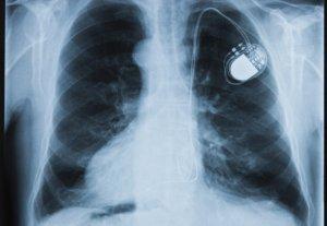 Implant Files: giornalisti denunciano lo scandalo delle protesi killer pacemaker