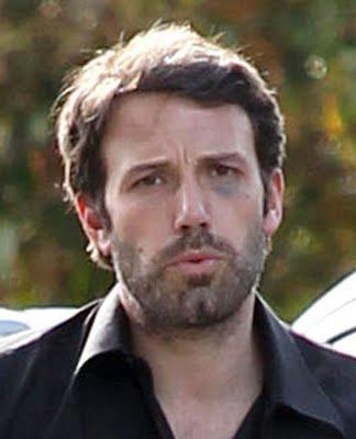 Ben Affleck e il mistero dell'occhio nero