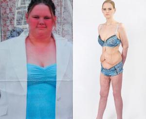 Perde 130 kg e diventa anoressica: ora ha 6 mesi di vita