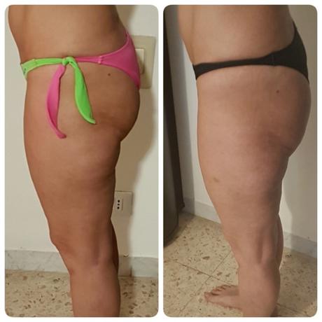 WORLD OF BEAUTY: CELLULITE DI TIPO MOLLE O FLACCIDO WORLD OF BEAUTY: CELLULITE DI TIPO MOLLE O FLACCIDO