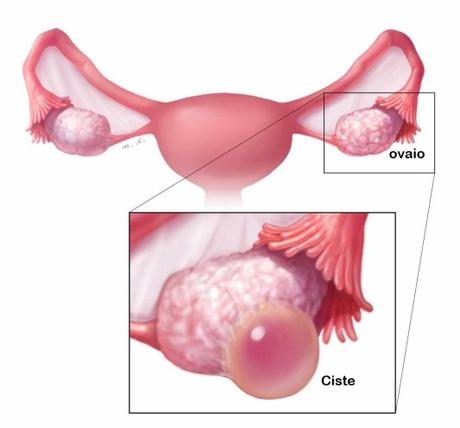 Le cisti ovariche emorragiche normalmente non influiscono sulla fertilità ciste-ovariche