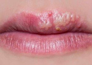 Herpes labiale: i concetti chiave dei rimedi più indicati herpes labiale