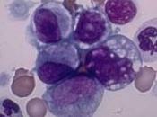 Gaslini scoperta funzione dell’interleuchina (IL-27) relazione alle leucemie linfoblastiche bambino