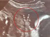 progresso scientifico contro l’aborto: oggi opera feto umano settimane