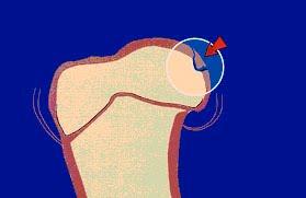 L’Osteocondrite Dissecante (OCD) della Spalla nel Cane.