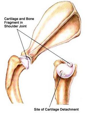 L’Osteocondrite Dissecante (OCD) della Spalla nel Cane.