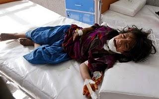 Mohammad Shoiab (REUTERS): Afghan girl awaits treatment in a Herat hospital, June 20, 2010