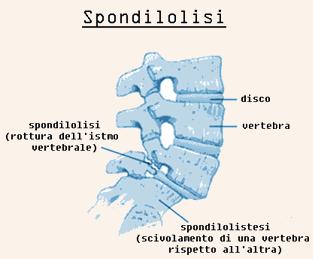 La Spondilolistesi