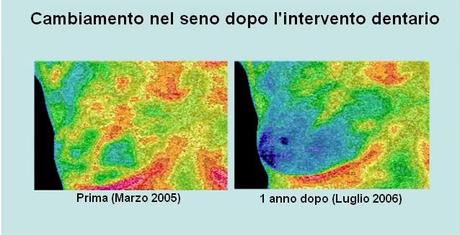 DONNE: TUMORE AL SENO E DENTI DEVITALIZZATI - (dal Dott. Lorenzo Acerra Comi.L.Va.)
