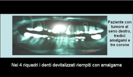 DONNE: TUMORE AL SENO E DENTI DEVITALIZZATI - (dal Dott. Lorenzo Acerra Comi.L.Va.)