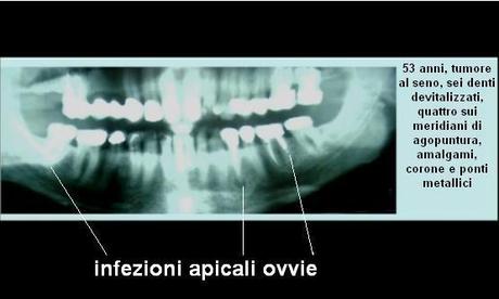 DONNE: TUMORE AL SENO E DENTI DEVITALIZZATI - (dal Dott. Lorenzo Acerra Comi.L.Va.)