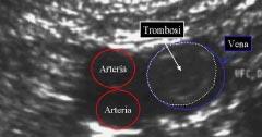 trombosi venosa: i fattori di rischio