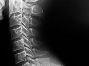 Frattura processo spinoso Giorno Cervical spinous process fracture.