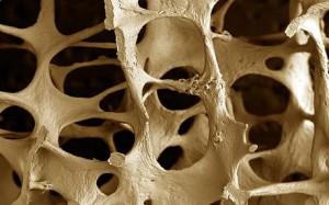 Test on line osteoporosi, rischi per una donna di 50 anni