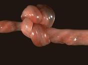 Conservazione cordone ombelicale: esiste libertà scelta Italia?